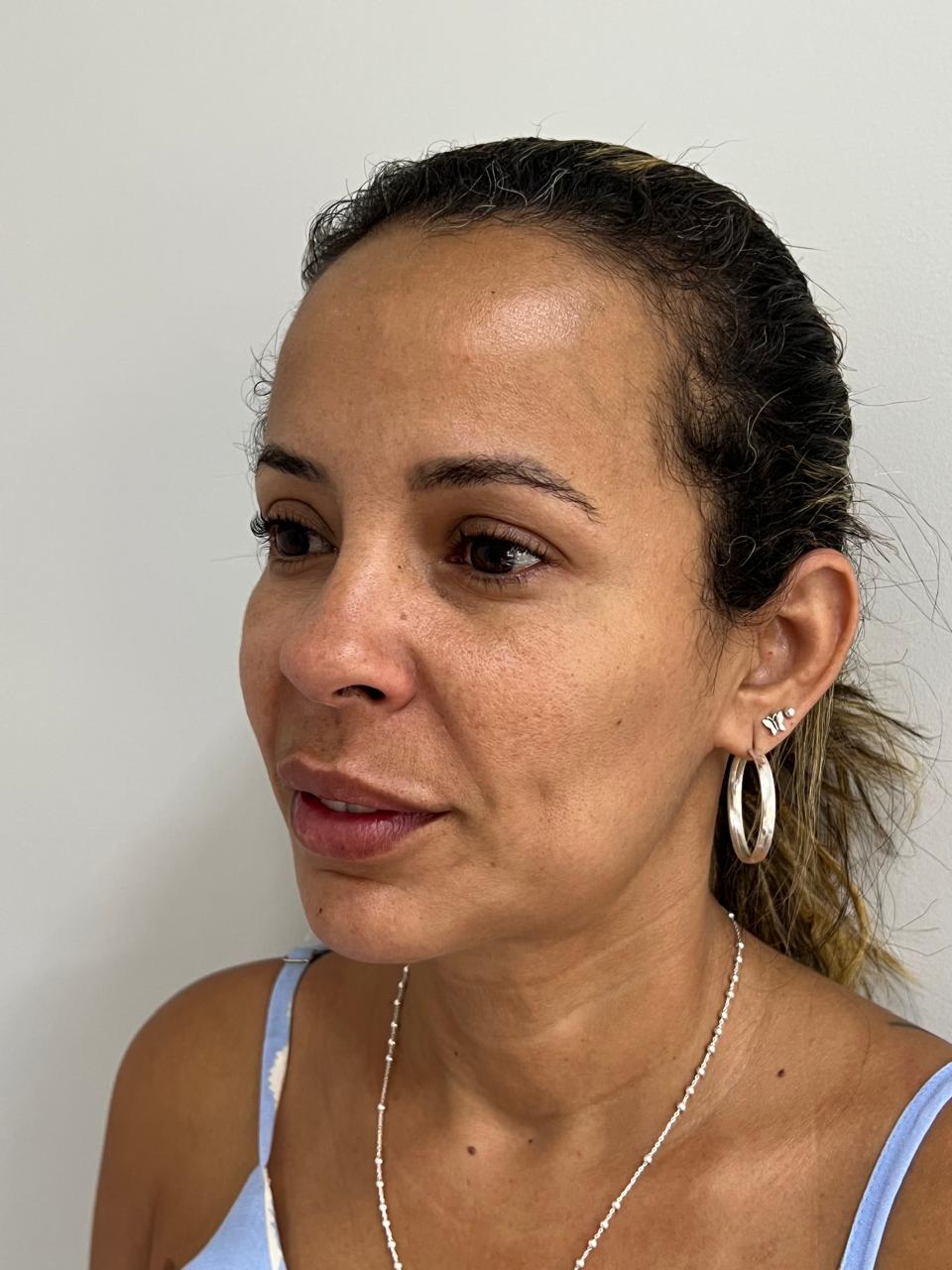 Antes - Harmonização Facial