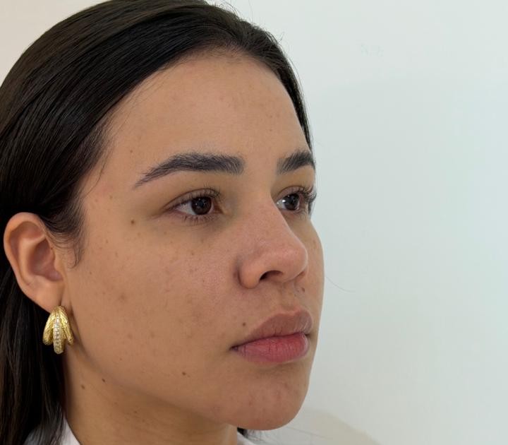 Antes - Preenchimento Labial