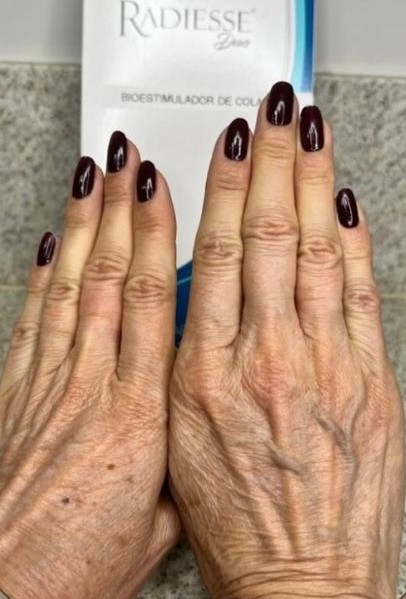 Antes - Rejuvenescimento das Mãos