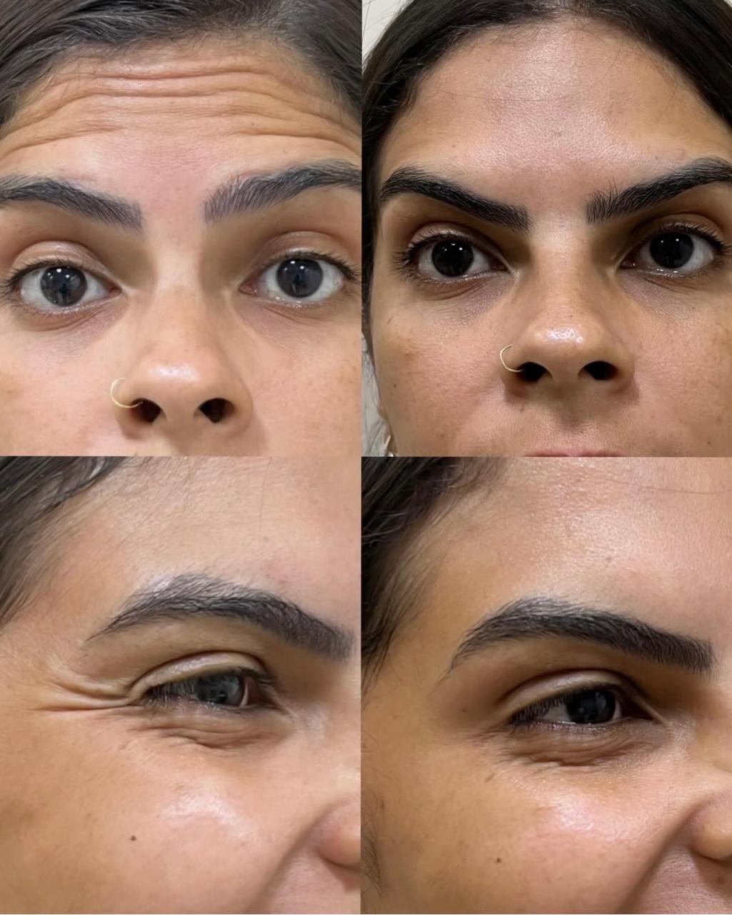 Antes e Depois - Botox
