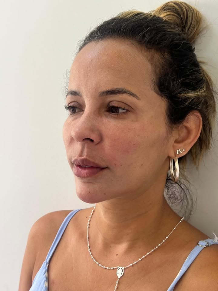 Depois - Harmonização Facial