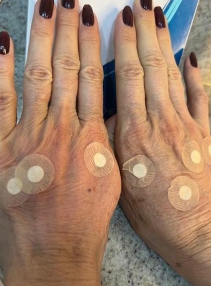 Depois - Rejuvenescimento das Mãos
