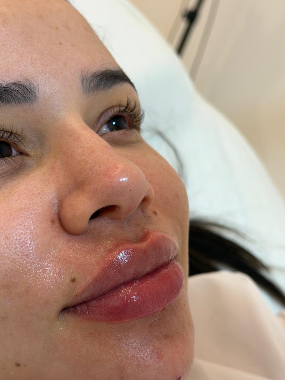 Depois - Preenchimento Labial