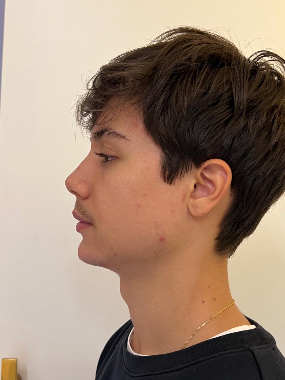 Depois - Preenchimento de Queixo